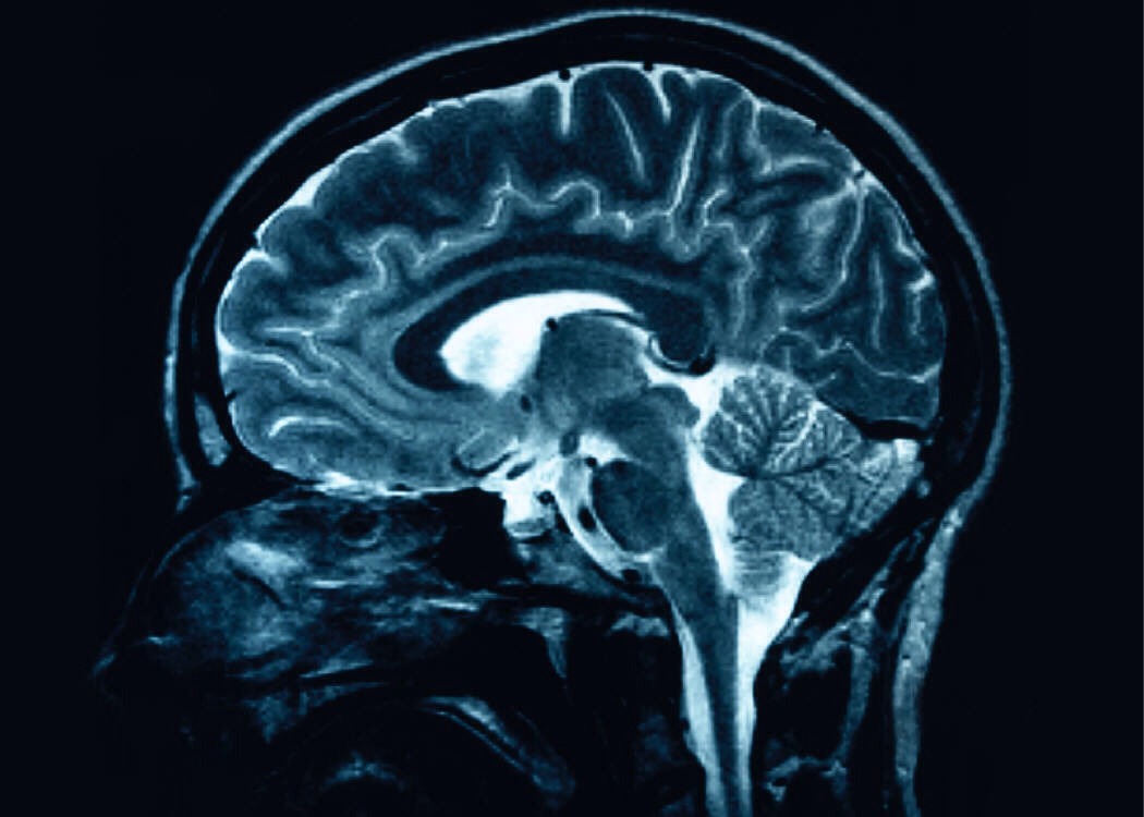 5. Reduced Alzheimer's risk. 
Eating Mediterranean may help cut your chance of Alzheimer's disease by 40 percent, shows a new study in the Journal of the American Medical Association. And people who added regular exercise to the diet were 60 percent less likely to get Alzheimer's.
