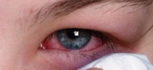 Few drops in the eye cures pink eye